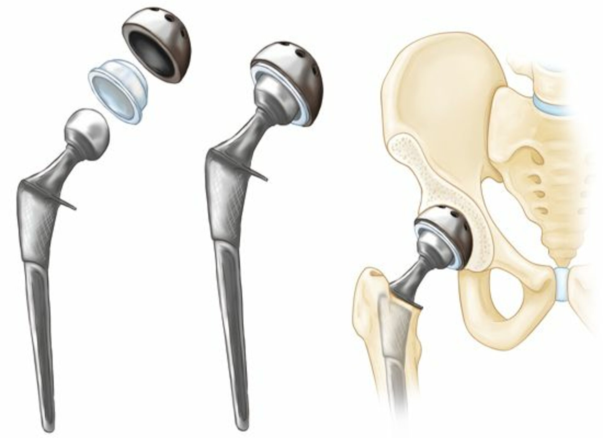 Primary &amp; Revision Total Hip Replacement