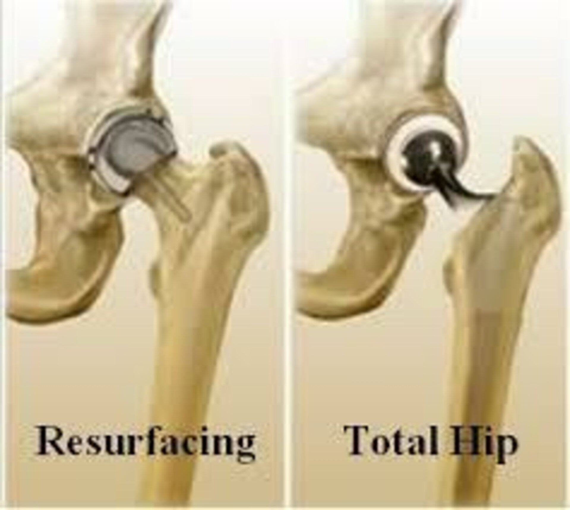 resurfacing total hip replacement
