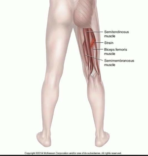 Hamstring Strain
