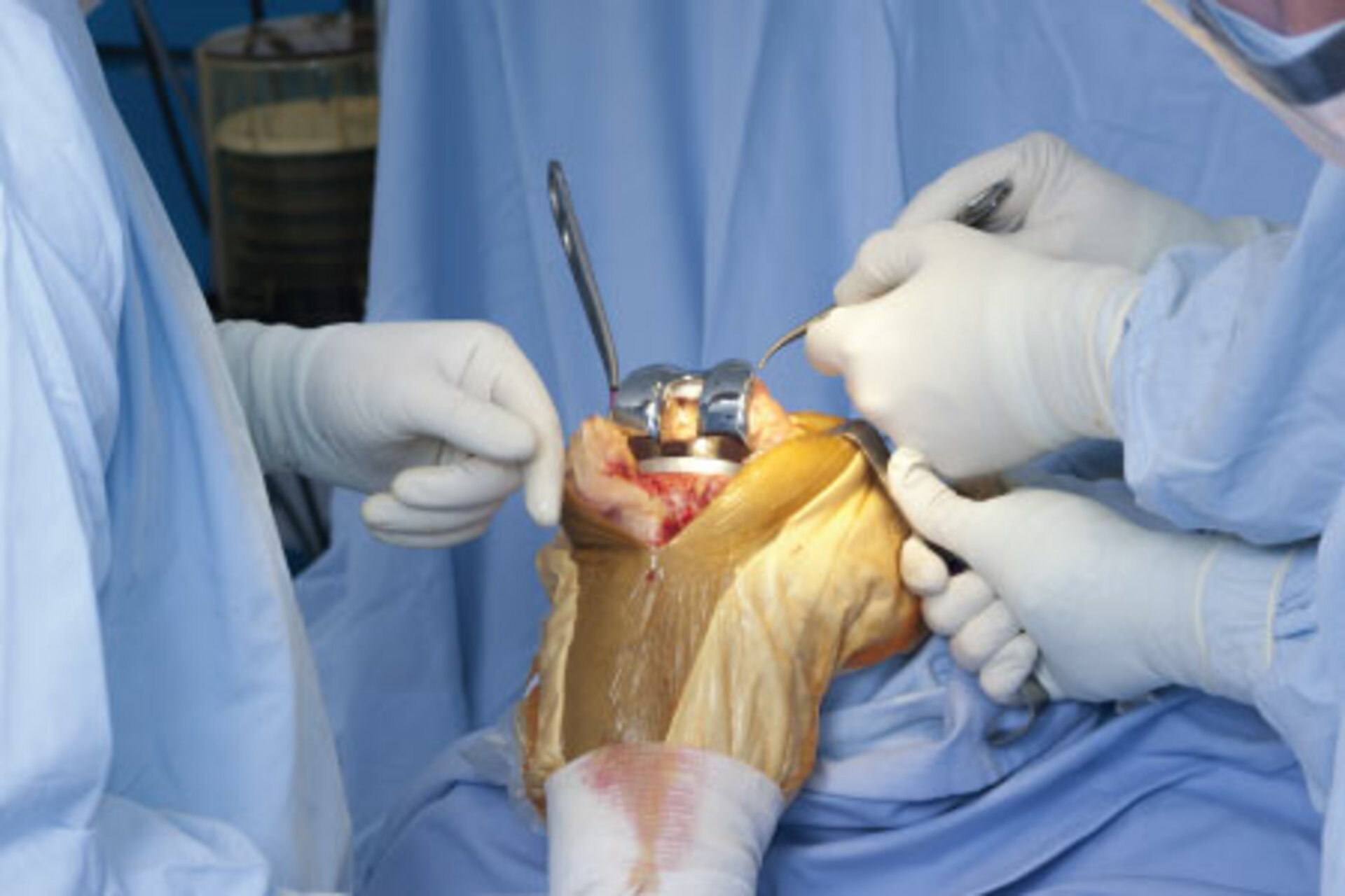 Robotic Knee Replacement