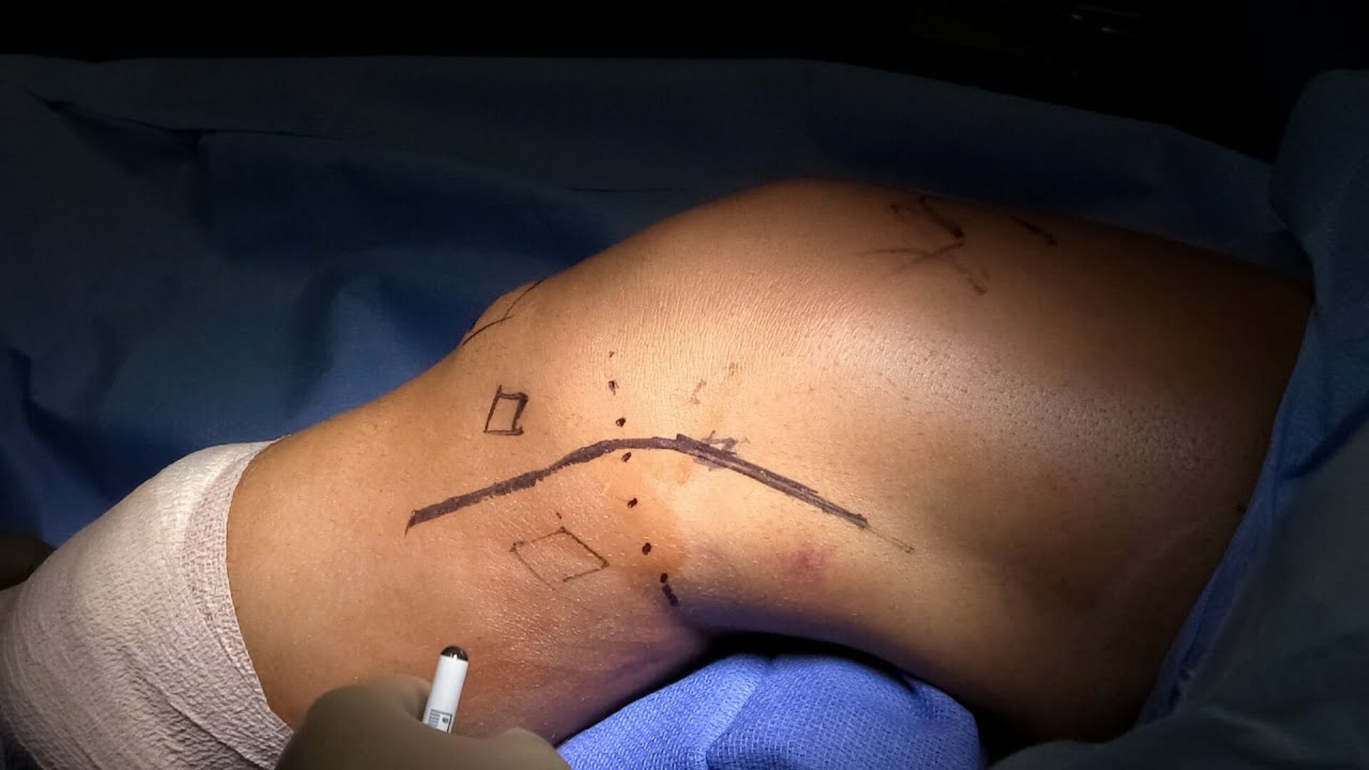 Meniscus Repairs/ACL/PCL/MCL/PLC reconstruction