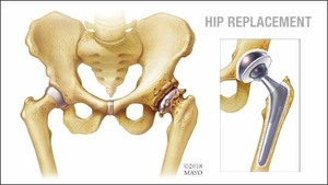 Hip Replacement in pune - Dr Nakul Shah