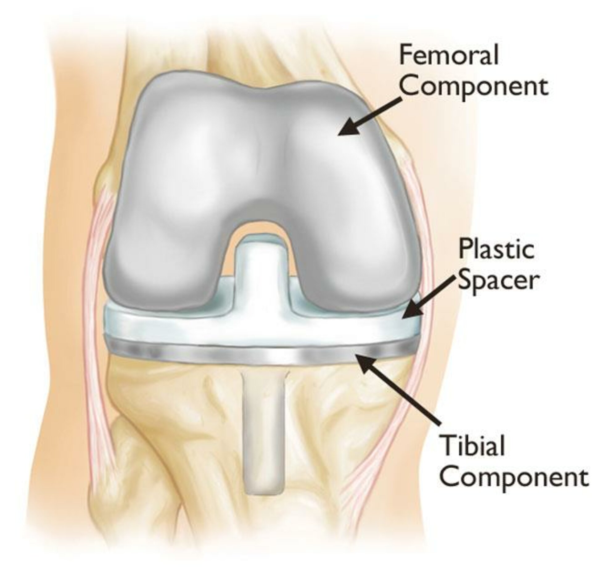 Primary &amp; Revision Total Knee Replacement