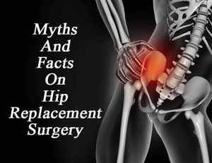 Myths and facts on Hip Replacement Surgery