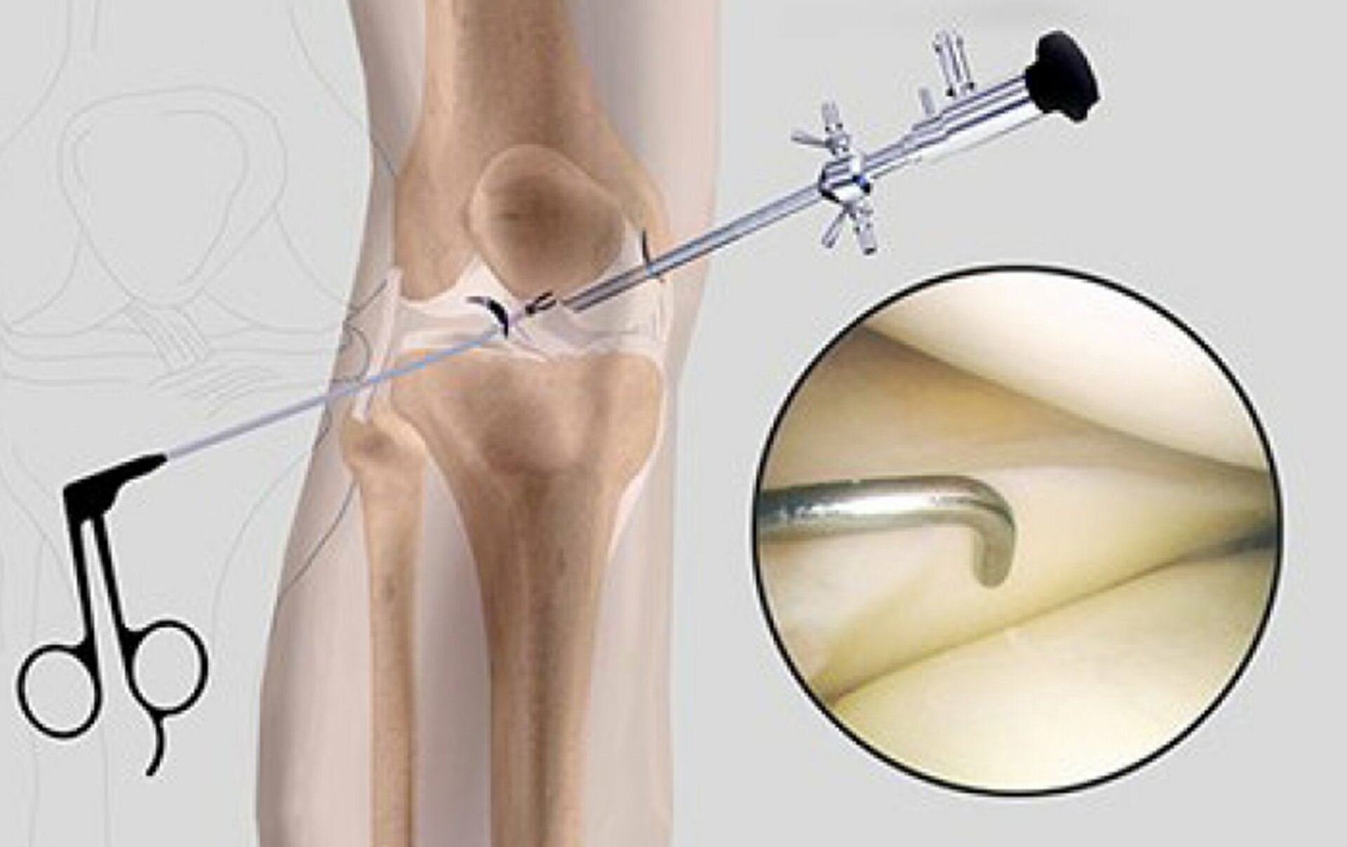 knee Arthrocsopy