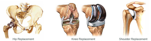  Joint Replacement Surgery