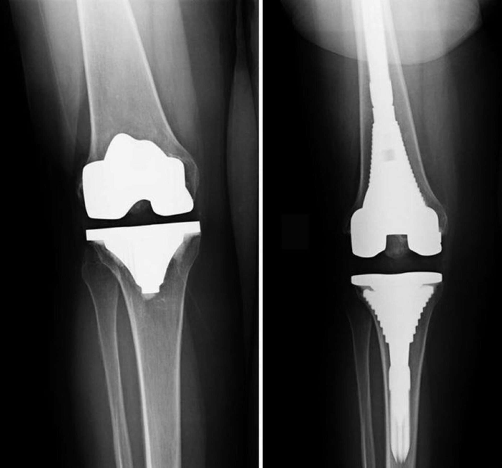 Revision of joint replacement